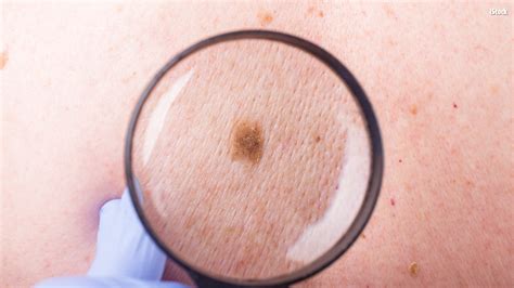 Woman 24 Recovering From Skin Cancer That Looked Like A Pimple Kiro