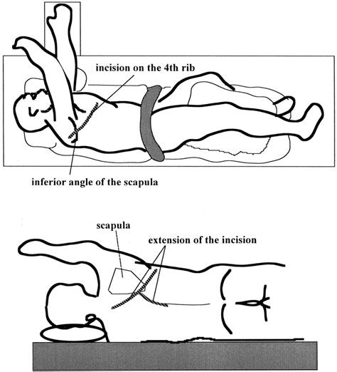 Drawings Illustrating Placement Of The Skin Incision Upper A