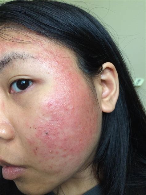 Allergic Reaction To Regimen Products