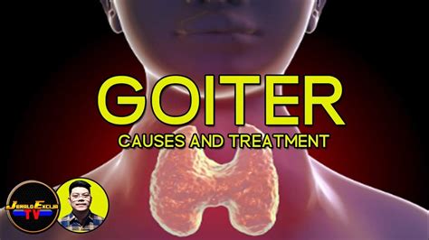 Goiter Causes And Treatment Youtube