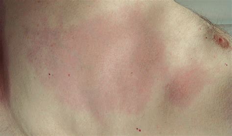 Erythematous Plaques On The Trunk Clinical Advisor