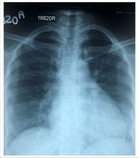 Chest X Ray Ap View Showing Mild Cardiomegaly With Obliteration Of
