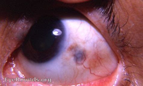 Sclera Residual Plaque Of Thinned Sclera Following Nodular Scleritis