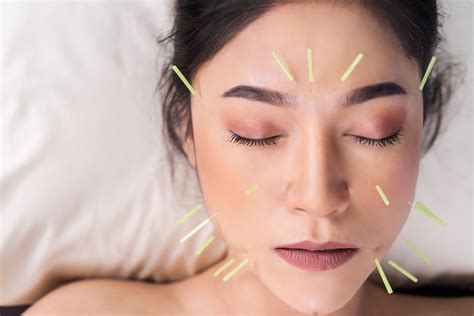 Cosmetic Acupuncture In Herndon Virginia — Striving For Health