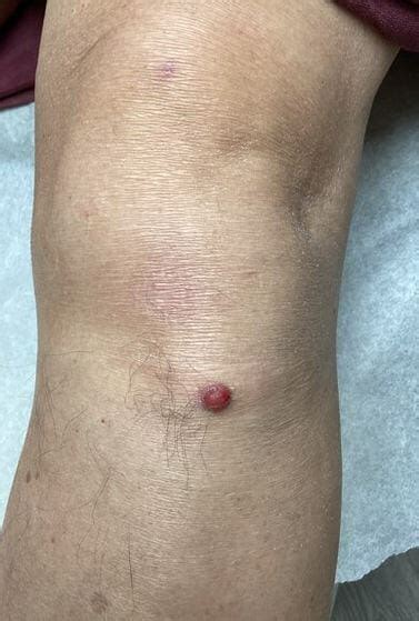 Clinical Challenge Red Nodule Below Knee Mpr