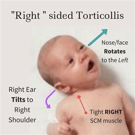 What Is Torticollis At Everything Babies