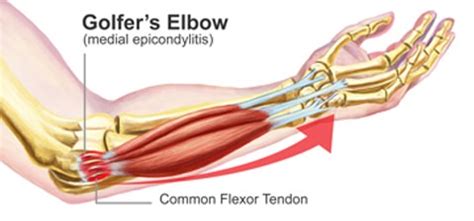 Allowing a runner to get back to running when nothing else has ever helped is a great feeling for a. Golfer's Elbow | Local Physio | Local Physio