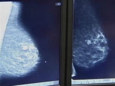 Most Women Can Now Wait Till Age 45 To Begin Breast Cancer Screening