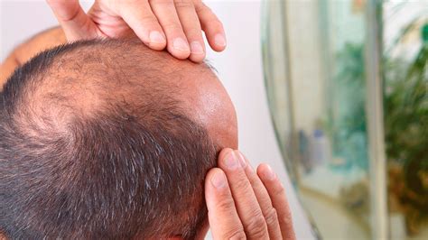 ¿cómo Poner Fin A La Alopecia Mejores Tratamientos Capilares Para