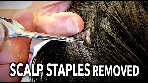 Scalp Staples Removed Quick And Mostly Painless Dr Paul Youtube