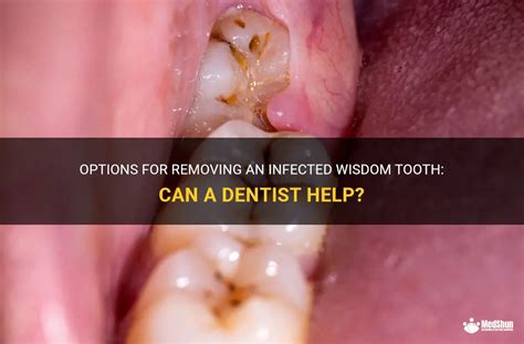 Options For Removing An Infected Wisdom Tooth Can A Dentist Help