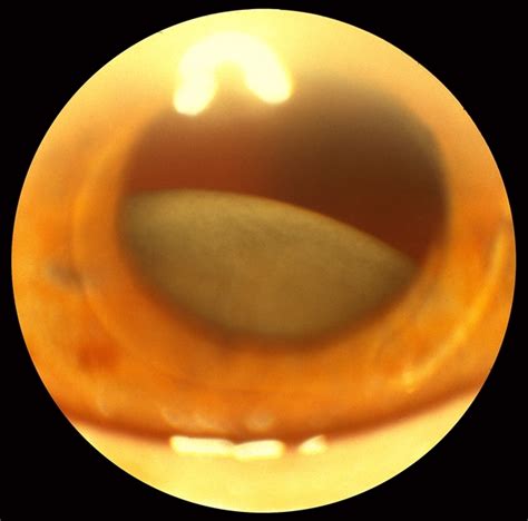 Traumatic Dislocated Crystalline Lens Retina Image Bank