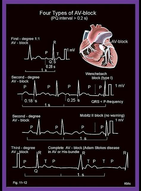 Ecg Heart Block Rhythms Four Types Of Atrio Ventricular Av Block