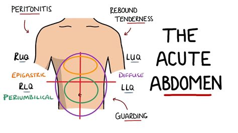 Acute Abdomen A Guide To Acute Abdominal Pain Youtube