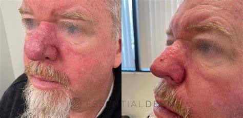 Rhinophyma Before And After Pictures Case 32 Natick Ma Essential