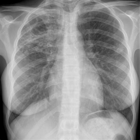 Tuberculosis Right Upper Lobe Cavitation Image Radiopaedia Org