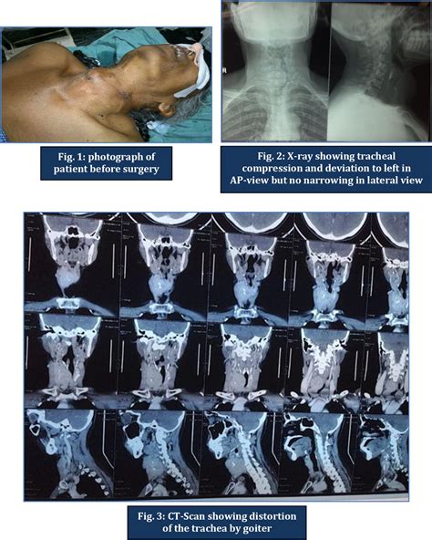 Figure 2 From Successful Airway Management Of A Case Of Multinodular