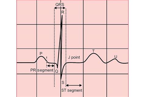 5 Lead Ecg Placement And Cardiac Monitoring Ausmed