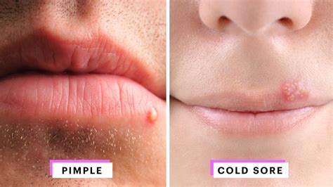 How To Identify A Herpes Cold Sore Vs Pimple Expert Advice Allure