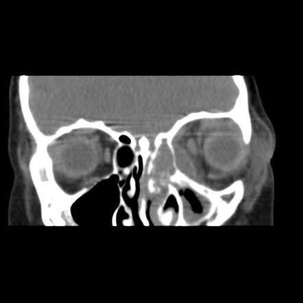 Subperiosteal Abscess Of The Orbit Radiology Case Radiopaedia Org