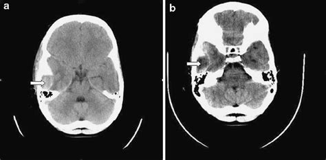 A And 2b Ct Scan Showing Right Temporal Extradural Hematoma In