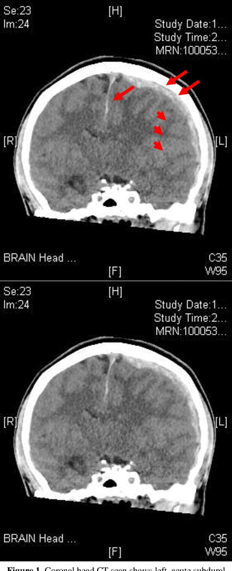 Figure 1 From A Case Report Of Acute Nontraumatic Spontaneous Subdural