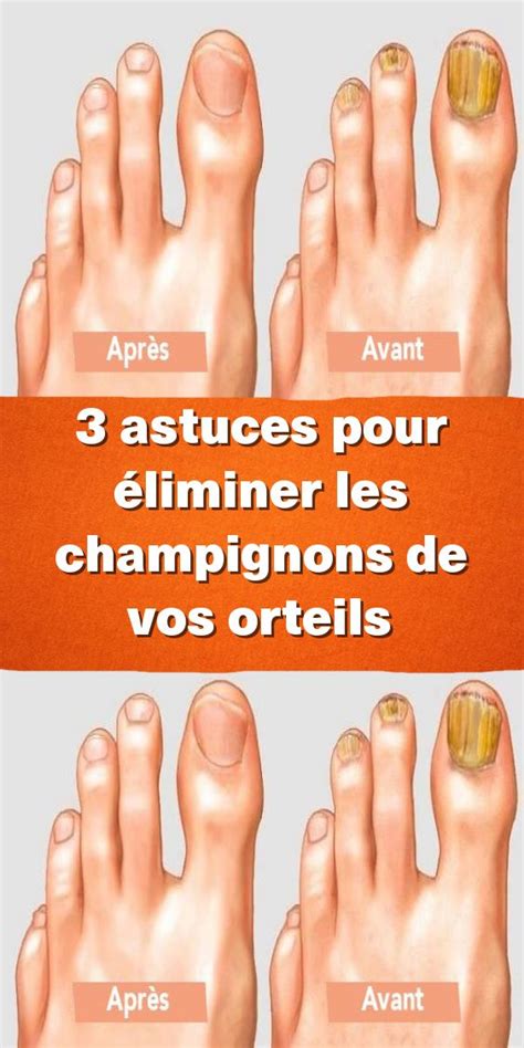 3 Astuces Pour éliminer Les Champignons De Vos Orteils En 2020