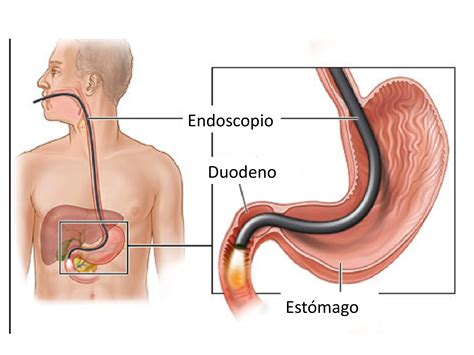 Gastroscopia qué es cómo se hace para qué sirve Consulta Médico Digestivo y Endoscopia