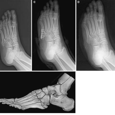 A 48 Year Old Man With A Fifth Metatarsal Base Fracture A Preoperative Download Scientific