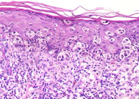 Primary Penile Melanoma With An Incidental Renal