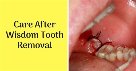 How To Take Care Of Wisdom Teeth Treatbeyond2