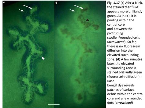 Dendritic corneal ulcer after fluorescein staining. Pediatric HSV Epithelial Keratitis - online presentation