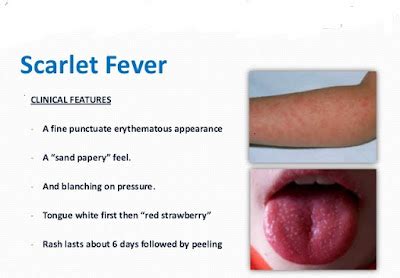 Pediatrics Notes Clinical Features Of Scarlet Fever