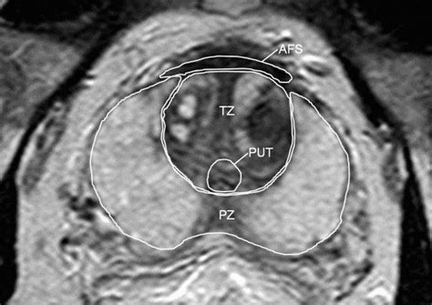 Zonal Prostate Anatomy On Axial T2 Weighted Mri Image Peripheral Zone