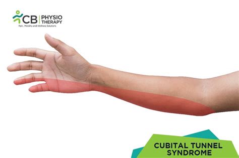What Is Cubital Tunnel Syndrome Symptoms Causes Diagnosis