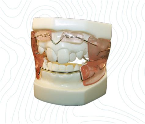 Frankel Appliance Ortholab China Orthodontic Laboratory