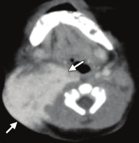 Kaposiform Hemangioendothelioma In A 1 Month Old Boy Who Presented With