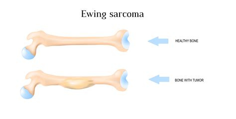 Treatment Of Ewings Sarcoma How Has It Changed Imaqpress