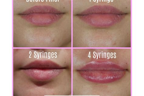 One Two Or Four Syringes Filler Lip Results Charmed Medispa