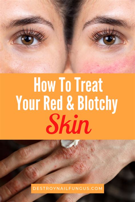 simple remedies to treat your blotchy skin