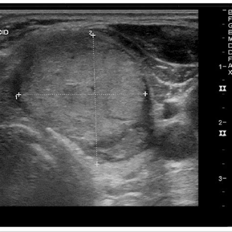 Thyroid Ultrasound With Transverse Image Of The Left Thyroid Lobe