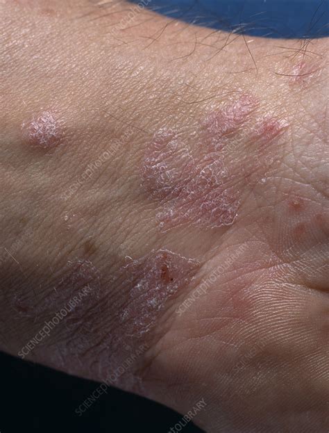 Psoriasis Stock Image M2400416 Science Photo Library