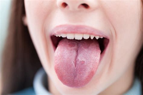 Burning Tongue Symptoms Causes And Other Risk Factors