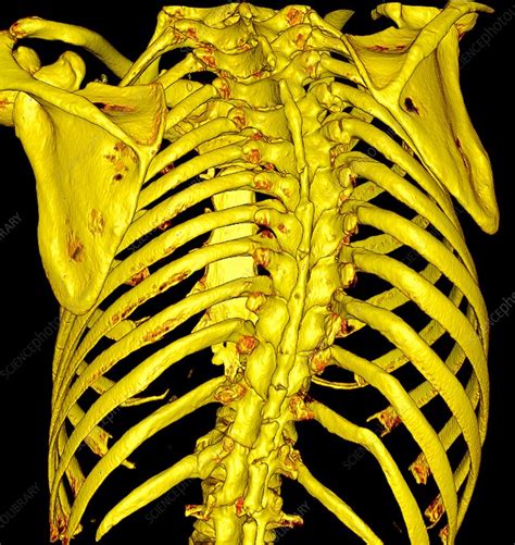 Scoliosis 3d Ct Scan Stock Image C0308356 Science Photo Library