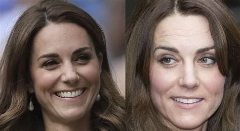 Kate Middleton Si è Fatta Il Botox La Bufala Che Fa Infuriare La Royal