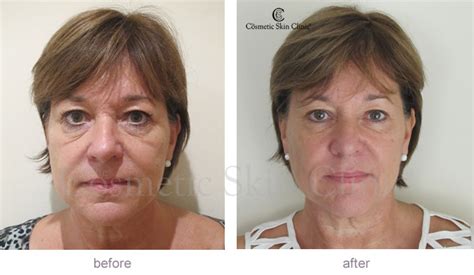 Tear Trough Fillers Before And After Photos
