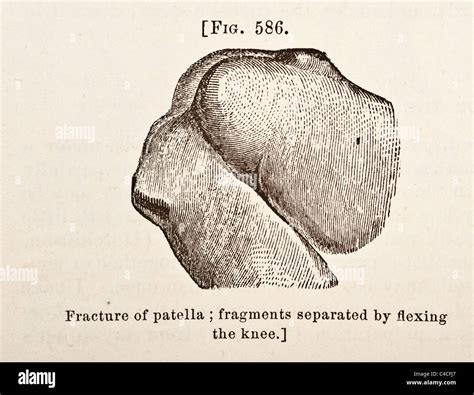 Antike Medizinische Illustration Der Patella Ca 1881 Stockfotografie