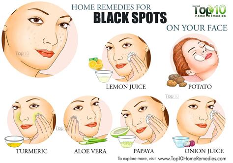 Pin By Ema Mugue On My Dark Spots On Face Spots On Face Black Spots