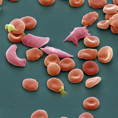 Gene Therapy Targets Sickle Cell Disease Scientific American