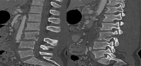 Sagittal Lumbar Ct Scan Showing L3 Fracture With Anterior Vertebral